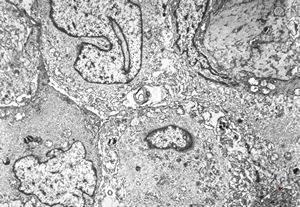 F,22y. | Pindborg tumor